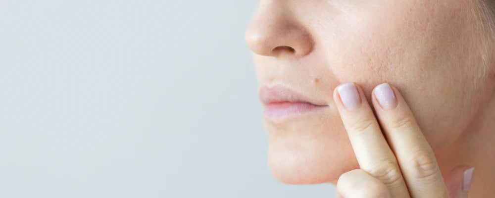 Pores dilatés